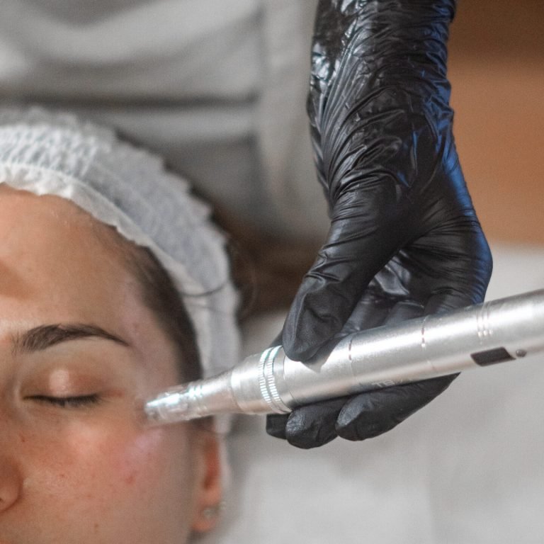 ratamientos de rejuvenecimiento y renovación profunda: microneedling, radiofrecuencia y exosomas en MCARMEN